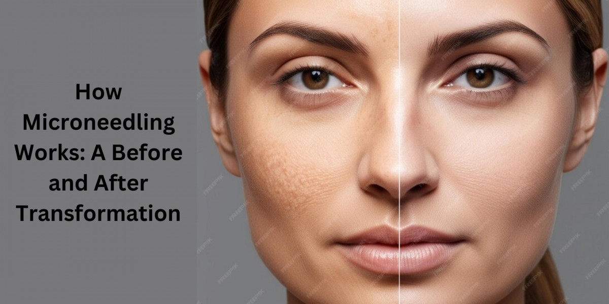 How Microneedling Works: A Before and After Transformation